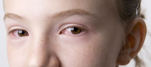 Picture of Pink Eye patient